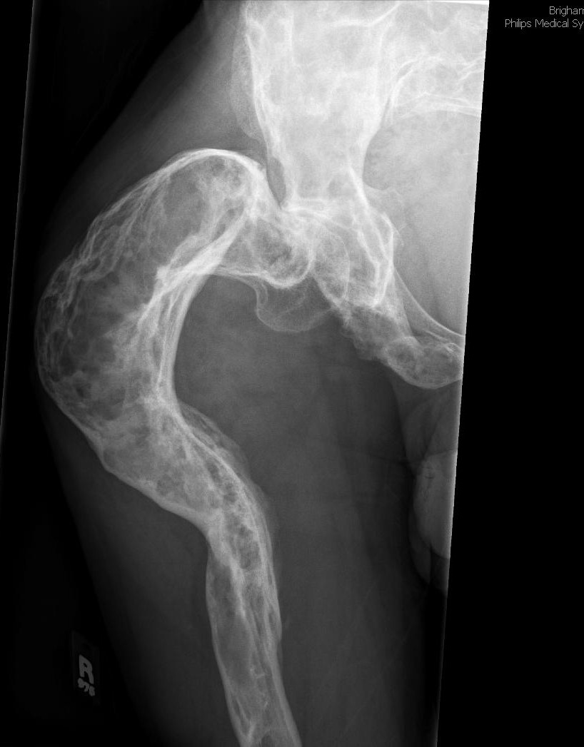 KhuranaBharti's tweet photo. Fracture through shepherd crook deformity-progressive varus and bowing due to polyostotic fibrous dysplasia #radres #MSKrad #EDrad #orthotwitter #MedTwitter #Medstudent #emergencymedicine https://t.co/kEB09gN5tr