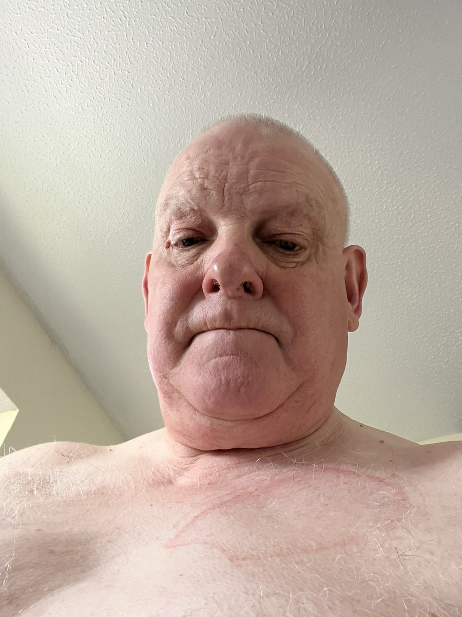 alanbullion2's tweet photo. Thanks again to the NHS for helping to keep for alive with a successful cardio version procedure at Pembury hospital 🏥 #safeintheirhands #NHS #pembury @twlabour @VoiceSherwood https://t.co/gT84YSuWOB