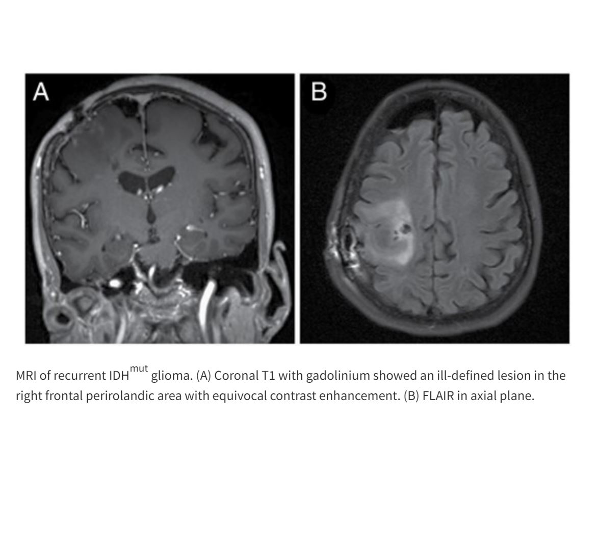 EditorNeuro's tweet photo. This reports an unusual case where a low-grade #glioma only had IDHmut and did not recur or cause breakthrough seizures until 22 years after diagnosis, without a progression in grade. Yet, seizures manifested at both original presentation and recurrence.
https://t.co/yrHNIAsJIZ https://t.co/BaRriNNlay