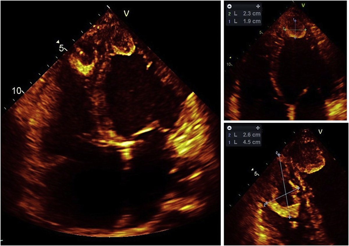 Ventricular thrombi are a known complication of peripartum cardiomyopathy: A unique cause of biventricular thrombi #EchoFirst @HatimLawati #CJCOpen 👉cjcopen.ca/article/S2589-…