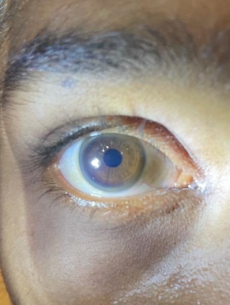 drpradeepck's tweet image. It’s satisfying experience when we diagnose a treatable neurological disorder looking at the eyes.   

#medtwitter #neurotwitter