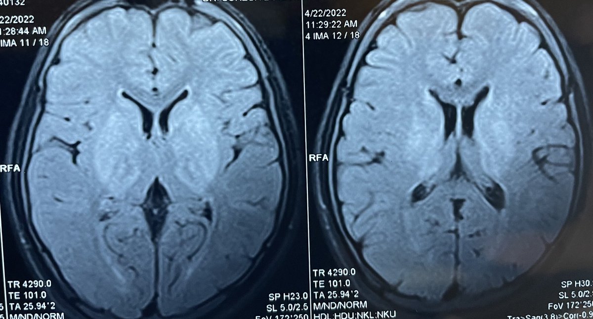 drpradeepck's tweet image. It’s satisfying experience when we diagnose a treatable neurological disorder looking at the eyes.   

#medtwitter #neurotwitter