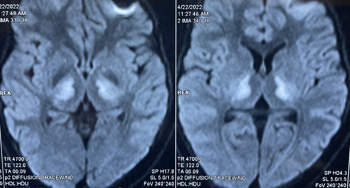 drpradeepck's tweet image. It’s satisfying experience when we diagnose a treatable neurological disorder looking at the eyes.   

#medtwitter #neurotwitter