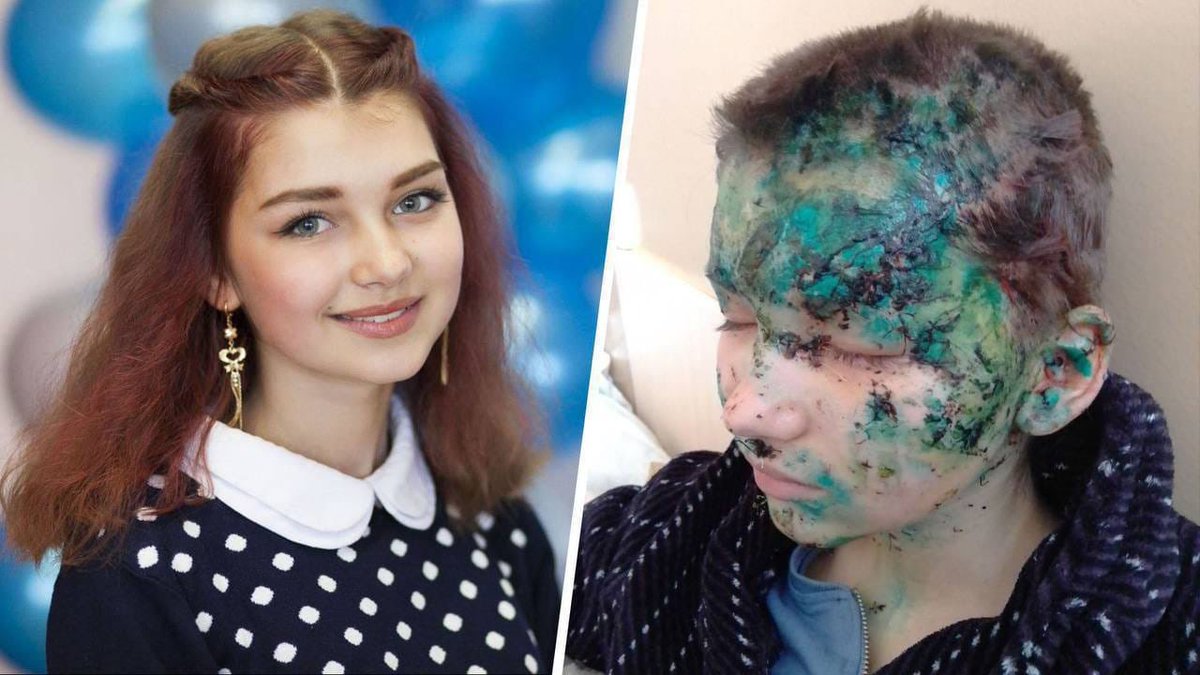 This is Maryna. She is one of 386 🇺🇦 children injured by russian aggression. 208 more have been killed by russian war criminals. Children are the future which we are now fighting for with our lives. Give us an opportunity protect it. Close the sky!
#ArmUkraineNow