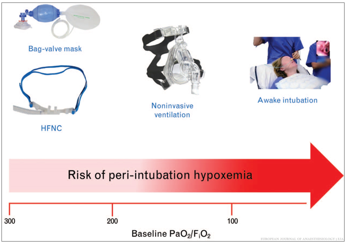 EJA_Journal's tweet photo. From @RussottoVin @LuaRahmani @MatteoParotto @GicoBellani and @johnglaffey.

Featured in the May 2022 issue of @EJA_Journal comes:  

Tracheal intubation in the critically ill patient

Click here: https://t.co/M9iowiTvoS https://t.co/0kjWiWaxjy