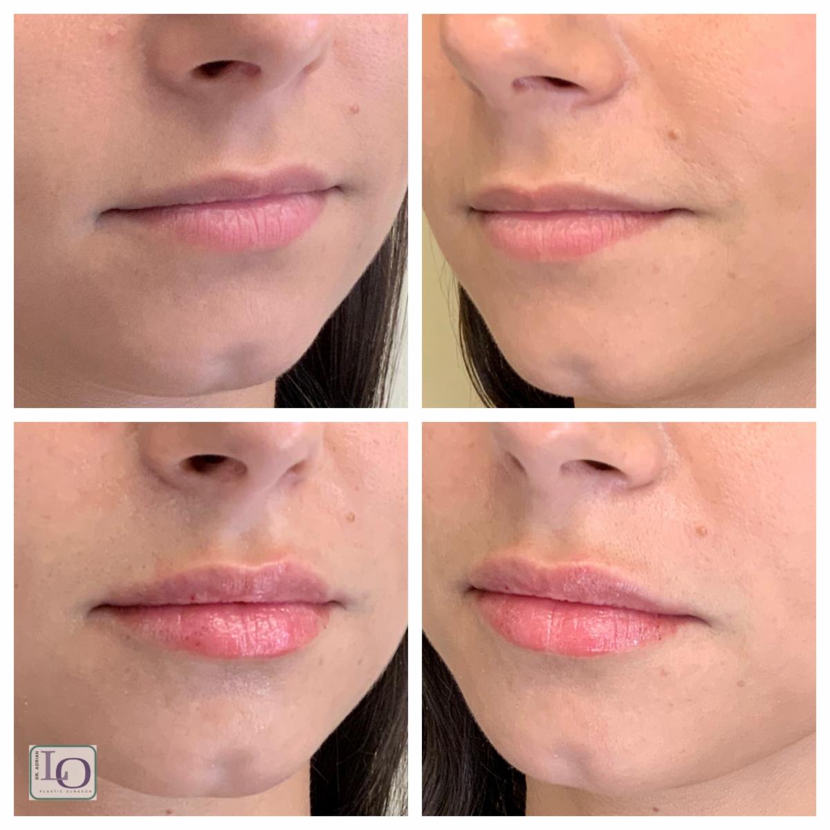 DrAdrianLo's tweet photo. 💉#FillerFriday💉 with *ONE* more week left to earn up to $180 in Allē points when treated with JUVÉDERM® and BOTOX® at the same visit! 💰 Contact us ASAP to secure your appointment with Annie before the end of the month! 😘 215.829.6900 https://t.co/4xlp8zjvpx