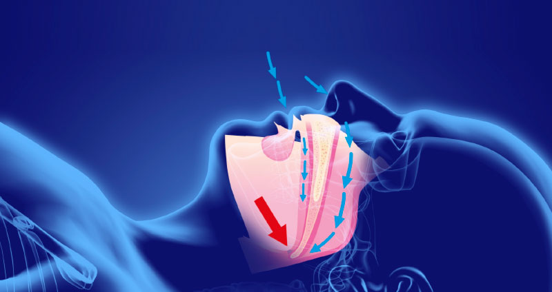 ClinicaCEMTRO's tweet photo. #Otorrinolaringología
El síndrome de #apneaobstructiva del sueño se produce por la ausencia de respiración espontánea (cesa la entrada de aire durante unos segundos)
Esto se origina por la combinación de #ronquidos frecuentes y la parada repentina de aire. https://t.co/bVaXWeRzPF