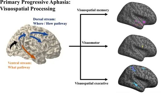 UCSF MAC (@ucsfmac) on Twitter photo Neuroanatomical correlations of visuospatial processing in primary progressive aphasia. Each PPA variant has a distinctive visuospatial cognitive profile that corresponds with grey matter volumetric changes. bit.ly/3EBGUcs
<a href="/LeadBoon/">Boon Lead</a> @DataCooker <a href="/kbcasaletto/">Kaitlin Casaletto</a> <a href="/AlbaLanguage/">ALBA Language Neurobiology laboratory</a> Neuroanatomical correlations of visuospatial processing in primary progressive aphasia. Each PPA variant has a distinctive visuospatial cognitive profile that corresponds with grey matter volumetric changes. bit.ly/3EBGUcs
<a href="/LeadBoon/">Boon Lead</a> @DataCooker <a href="/kbcasaletto/">Kaitlin Casaletto</a> <a href="/AlbaLanguage/">ALBA Language Neurobiology laboratory</a>