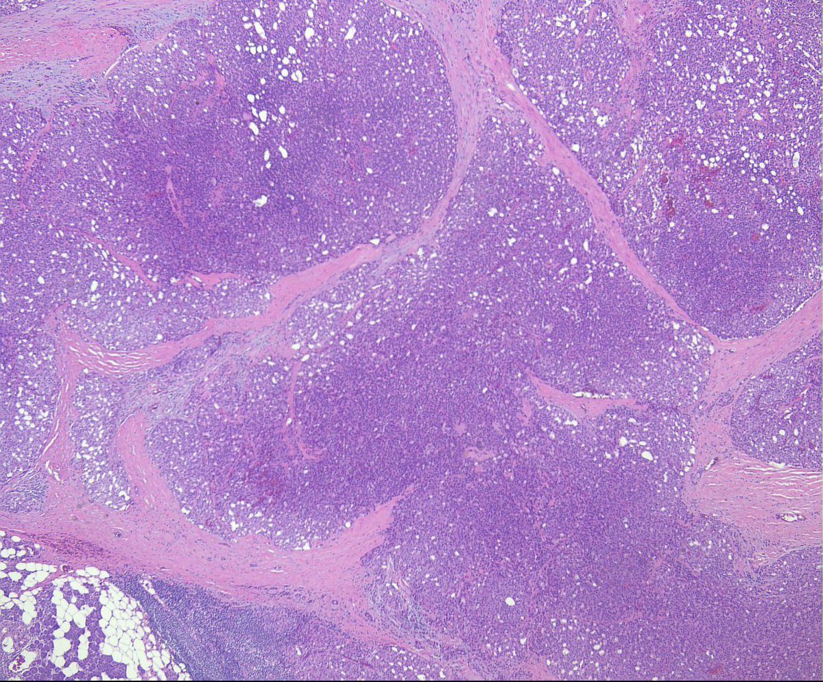 rhpath65's tweet photo. 45-year-old male, parotid mass. 
Acinic cell carcinoma. #aciniccellcarcinoma #parotid #headandneck #surgpath #dog1 #mass #salivarygland https://t.co/FmE2HqXGV9