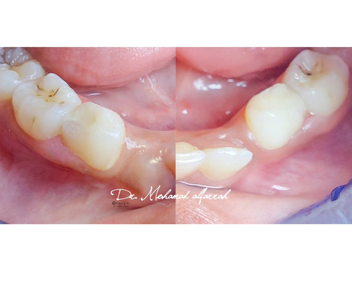 mohamadalfarrah's tweet image. Glass Inomer Cement Restoration for lovely child Nimco💕🥰
.
facebook.com.com/drmohamadalfar…
#dr_mohamad_alfarrah
#fiberpost #rootcanaltreatment
#compositerestoration
#mogadishu #Somalia #AddisAbaba #Ethiopia
#nairobi #kenya #irbil #iraq
#Hargeisa #Somaliland #nigeria #Rwanda