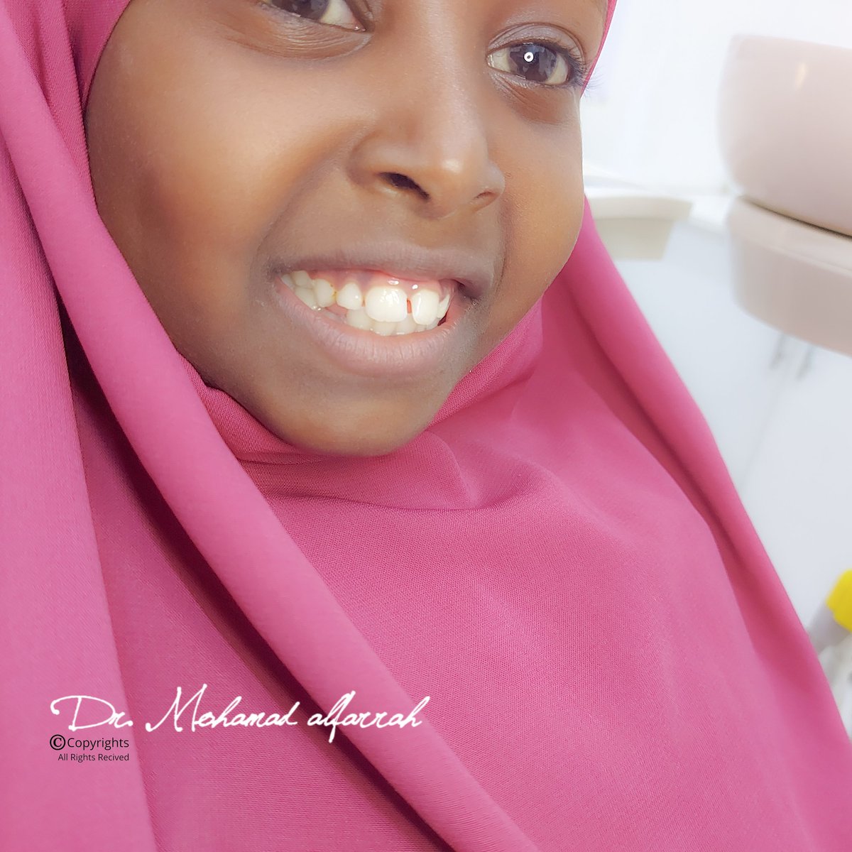 mohamadalfarrah's tweet image. Glass Inomer Cement Restoration for lovely child Nimco💕🥰
.
facebook.com.com/drmohamadalfar…
#dr_mohamad_alfarrah
#fiberpost #rootcanaltreatment
#compositerestoration
#mogadishu #Somalia #AddisAbaba #Ethiopia
#nairobi #kenya #irbil #iraq
#Hargeisa #Somaliland #nigeria #Rwanda