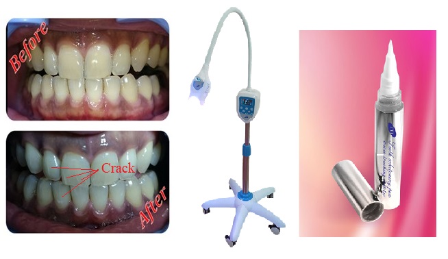 ttitwinkleteeth's tweet photo. Cracked teeth can cause acid sensitivity and are not suitable for teeth whitening.

TTI is Taiwan's leading tooth whitening manufacturer, offering salon tooth whitening products and consulting services.

#teethwhitening #teethbleaching #teethwhiting  #whitening  #cosmetic #salon https://t.co/RVMs10aqdp