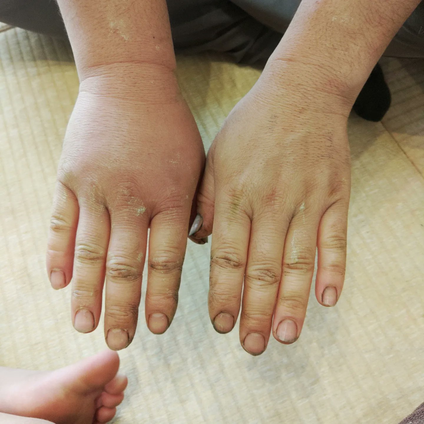 تويتر ミニトマトのあざみ農園 على تويتر 今日は定休日です ミニトマト栽培に欠かせない蜂 しかし 蜂と一緒にお仕事をすると 刺されることがあります まるで赤ちゃんの手のようにかわいく太っちゃいました 栽培 蜂 腫れ 刺された ミニトマト T