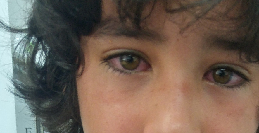 guerreroespejo's tweet photo. Dos #mellizos de 9 años y la #madre, una hora antes bocadillo de atún de lata, abierta varios días antes, en nevera: exantema macular eritematoso y pruriginoso en el cuerpo, con hiperemia conjuntival bilateral 
1/3

https://t.co/52FMREWT8W
#pediatria #dermatologia @aepediatria https://t.co/32WJndpRHK