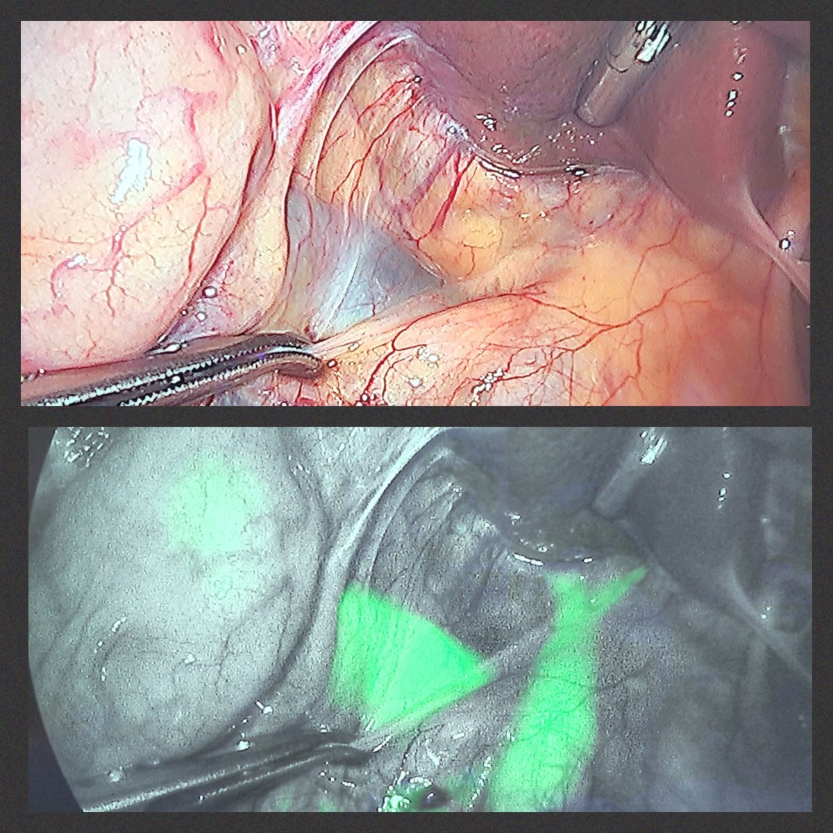 #ICG for #incisionlesscholangiography during #LC allows early visualisation of the Biliary tree not seen under white light. See the #CBD, right and left #HD, at the #hilum shining 🟩. #some4HPB #SoMe4Surgery