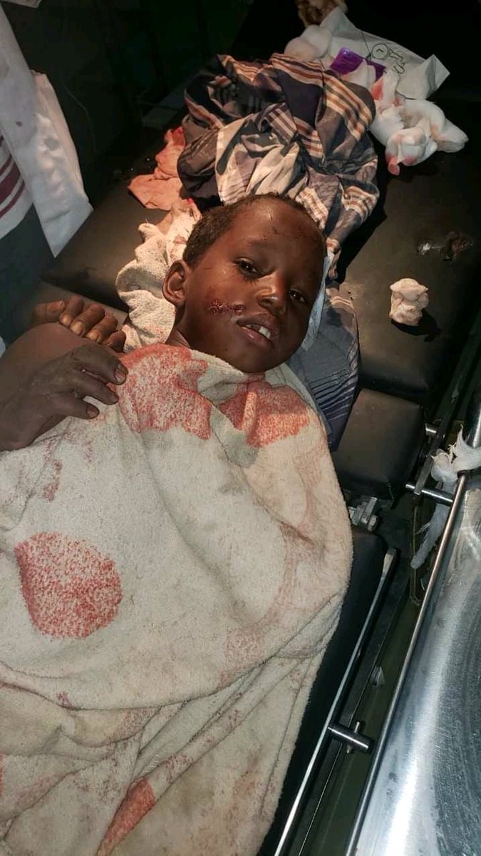lahadda88's tweet photo. Below are 2 twins who were seriously injured in a bomb blast that took place in the area of ​​Wantu &amp; Furs Kebele in Ada'ar Woreda, particularly Gedan Doga so this bomb was buried by #TPLFTerrorists during the war before 5 months. z 3rd child is receiving treatment in Darsagita. https://t.co/KZVWvYQUct