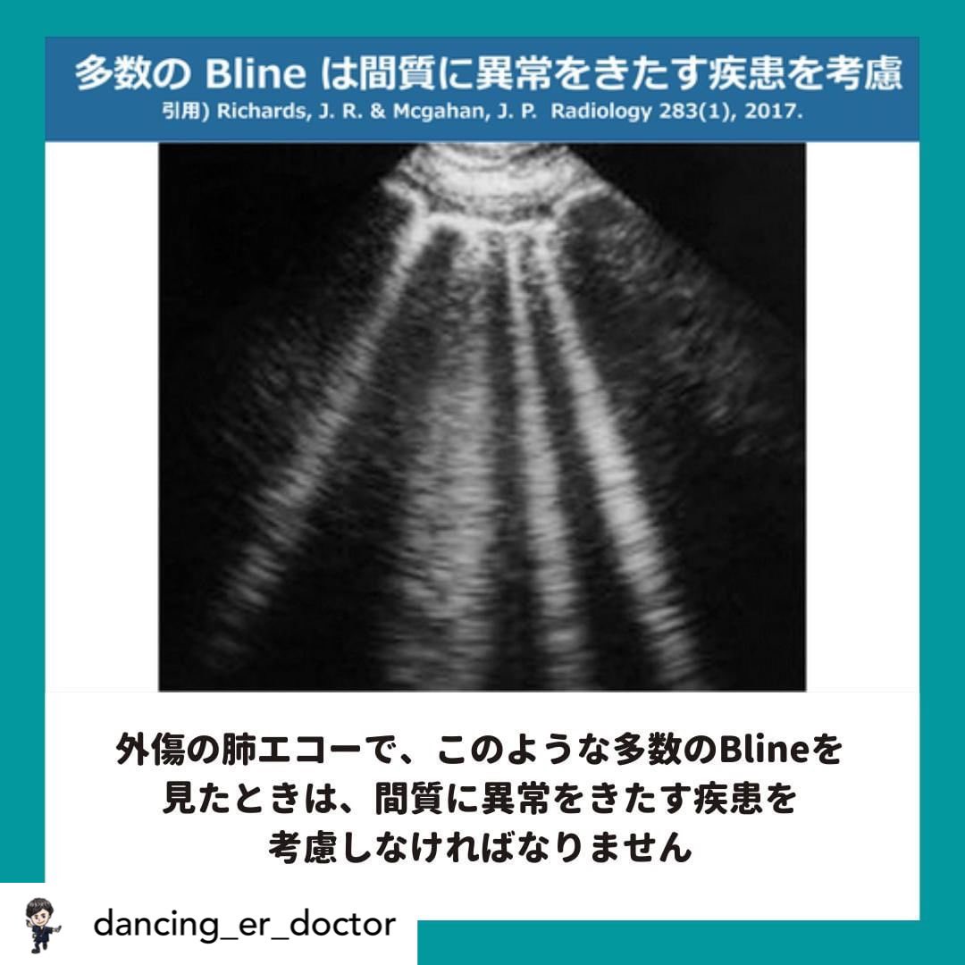 Blineとは、胸膜から垂直方向に延びる線であり、簡単に言うと液体を 