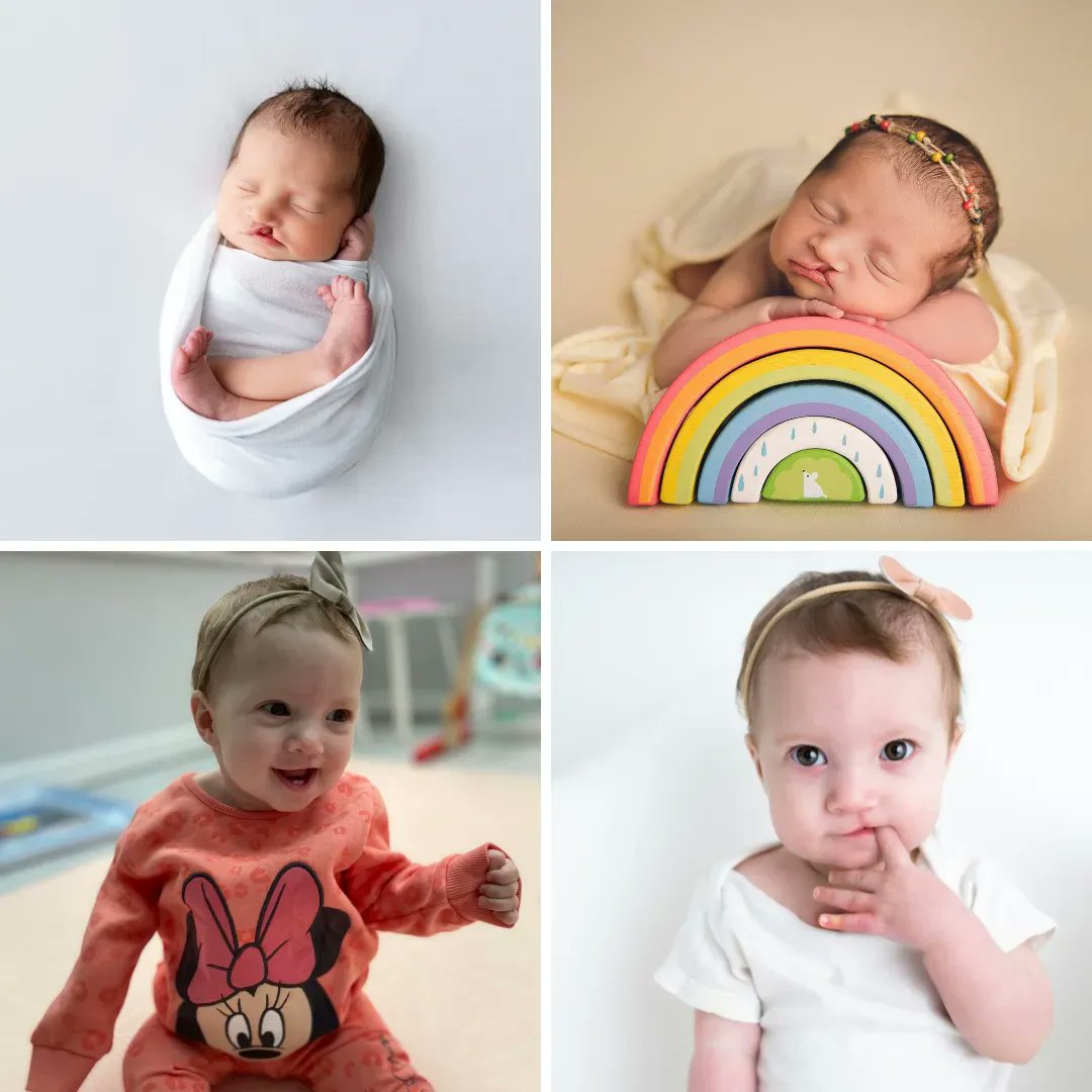 CLAPACOMMUNITY's tweet photo. Donna's daughter Eva was born with a unilateral cleft lip and palate. Now that Eva is nine months old, Donna reflects on their journey and shares her fundraising plans.
Read their full story on our website! ➡ https://t.co/VaVKLEDlB7
#Cleft #CleftLipAndPalate #CleftSupport https://t.co/niHFCDPX3M
