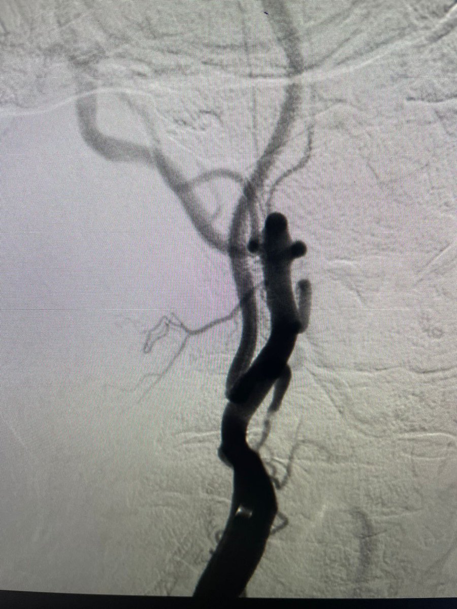 DrVipulGupta25's tweet photo. Challenging case of severe carotid stenosis with irregular plaque. There was a kink in the artery just distal to the narrowing which made it difficult to place the filter device. We navigated a neuro wire across the stenosis which straightened the artery, https://t.co/ylyuHfhzGI