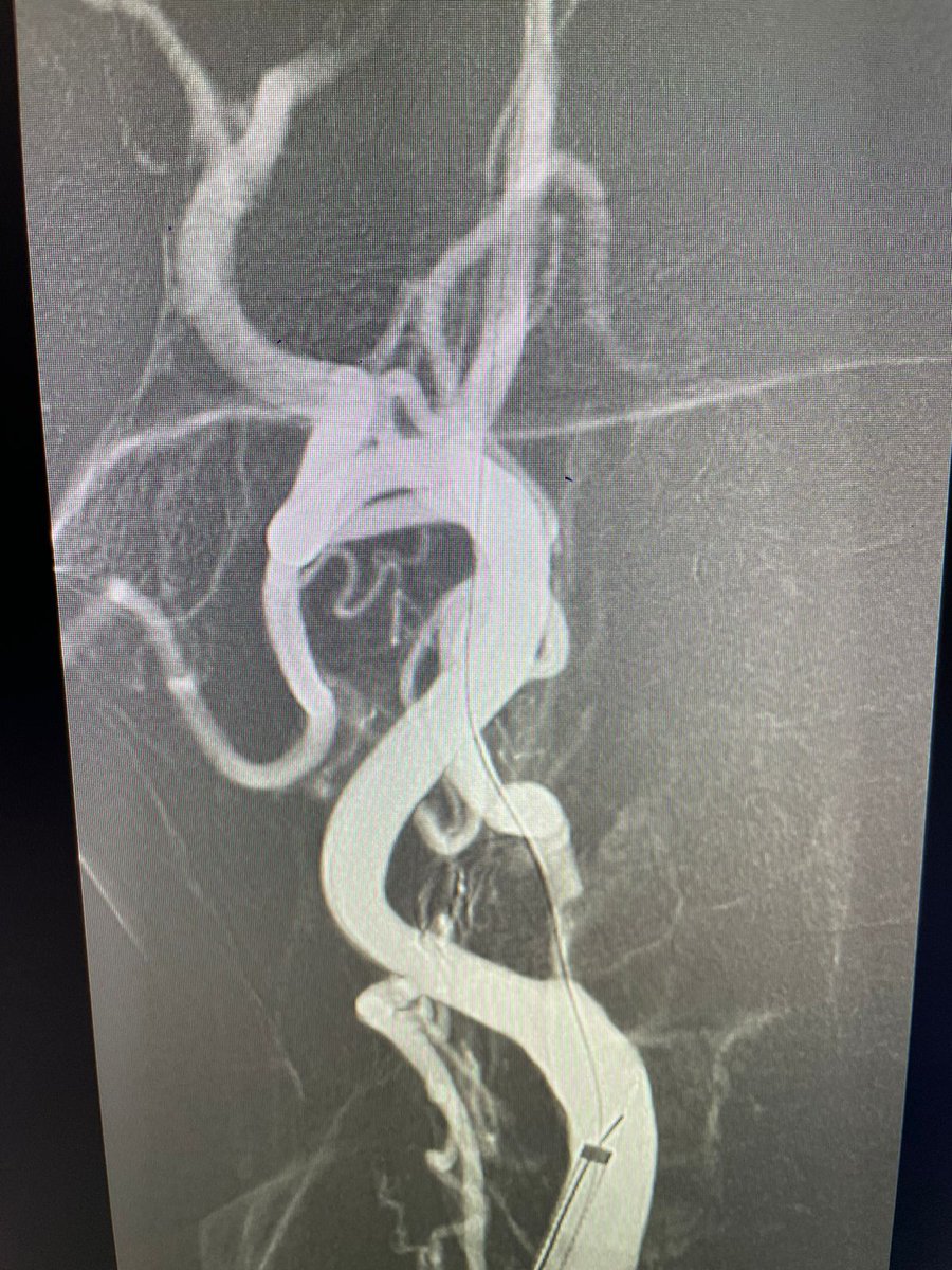 DrVipulGupta25's tweet photo. Challenging case of severe carotid stenosis with irregular plaque. There was a kink in the artery just distal to the narrowing which made it difficult to place the filter device. We navigated a neuro wire across the stenosis which straightened the artery, https://t.co/ylyuHfhzGI