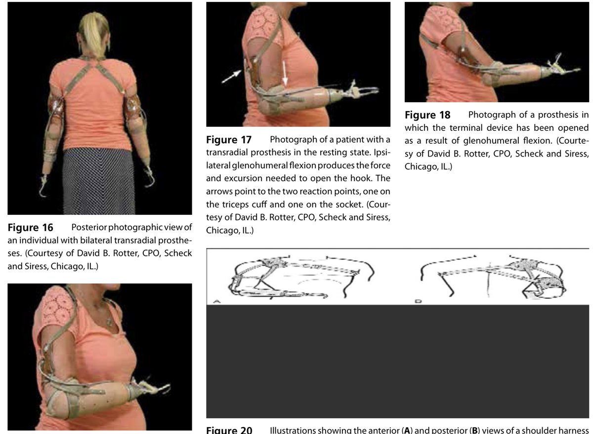 2.

الاجهزه المصنعه للمرضى ليست الا ادوات تكمل المكانيكا المفقوده من الخساره الناجمه عن بتر او عله عصبيه او عظمية. مثلا مبتورين transradial and transhumeral يقومون بتشغيل اجهزتهم والتحكم بالمدى الحركي للجهاز من مفصل الكتف كامل المكون من اربع مكونات.