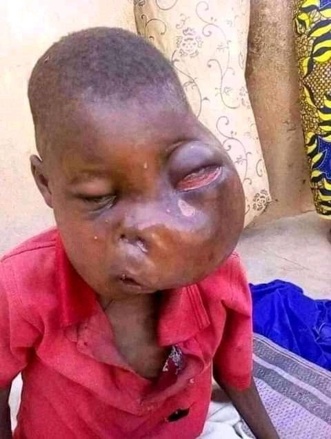 We call up on your support via this kid to gain his life please you can donate through this link world remitely.com details contact:+256758628231 Name:Ramadhan Bazibu Country:Uganda and its through airtel money