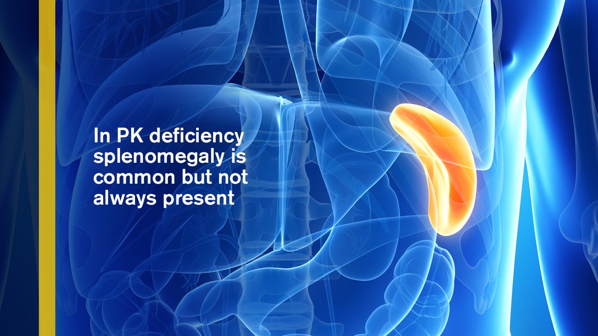 What Is Spleen? Causes, Signs, Symptoms Of Enlarged Spleen, 53 OFF