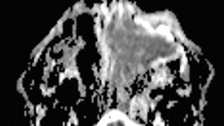 #InvertedPapilloma is usually one of my favorite diagnoses, bc it's benign & has that distinctive cerebriform pattern. But when that pattern is focally lost w ⬇️T2 signal & ADC, as in the lateral aspect of this mass, you have to worry about conversion to squamous cell ca. #HNRAD