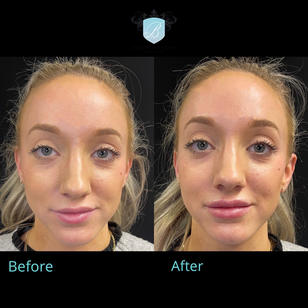 bellamedspa3's tweet photo. A subtle lip enhancement and this Bella Beauty is beyond happy!  #lipfiller #lipenhancement #dermalfillers #lipinjection #lipsbeforeandafter #drchacher #bellamebeautiful https://t.co/OJK3dLwSNe