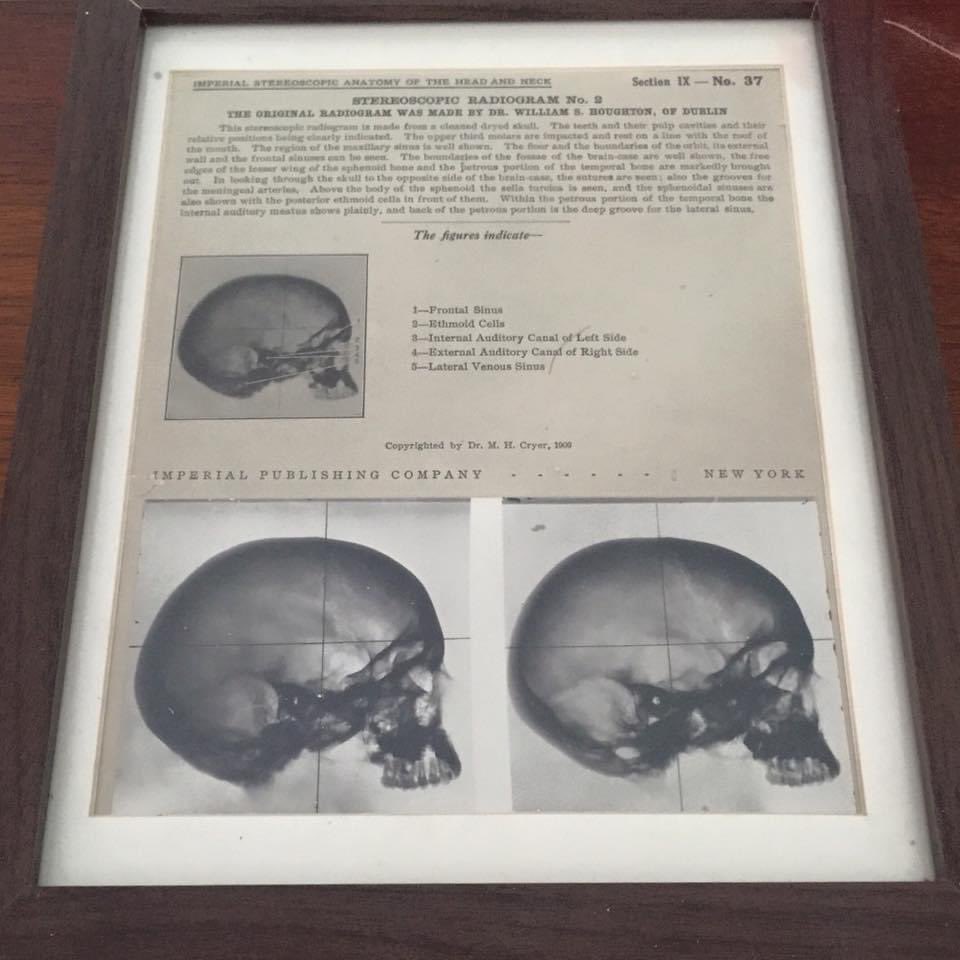 IMSS_Chicago's tweet photo. Stereoscopic Radiogram figures that indicate: 1) Frontal Sinus 2) Ethmoid Cells 3) Internal Auditory Canal of the Left Side 4) External Auditory Canal of Right Side 5) Lateral Venous Sinus #imsschicago #chicago #museum #medicine #medicalhistory https://t.co/wwbBFO3PD1
