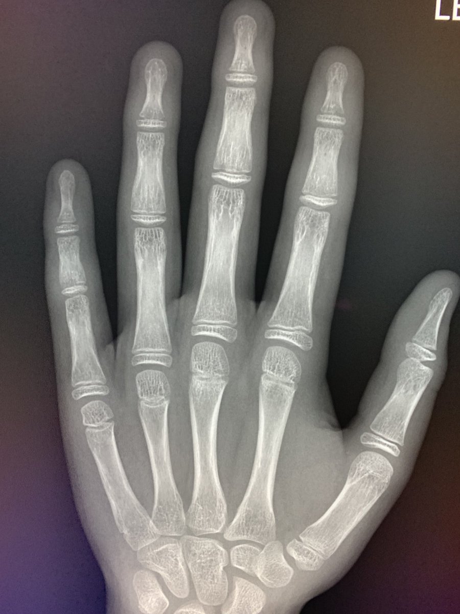 northwoods1980's tweet photo. Favorite case in a while. 10-year-old male with hand pain and swelling presents to pediatrician. Thoughts? https://t.co/caAoS9dvYu