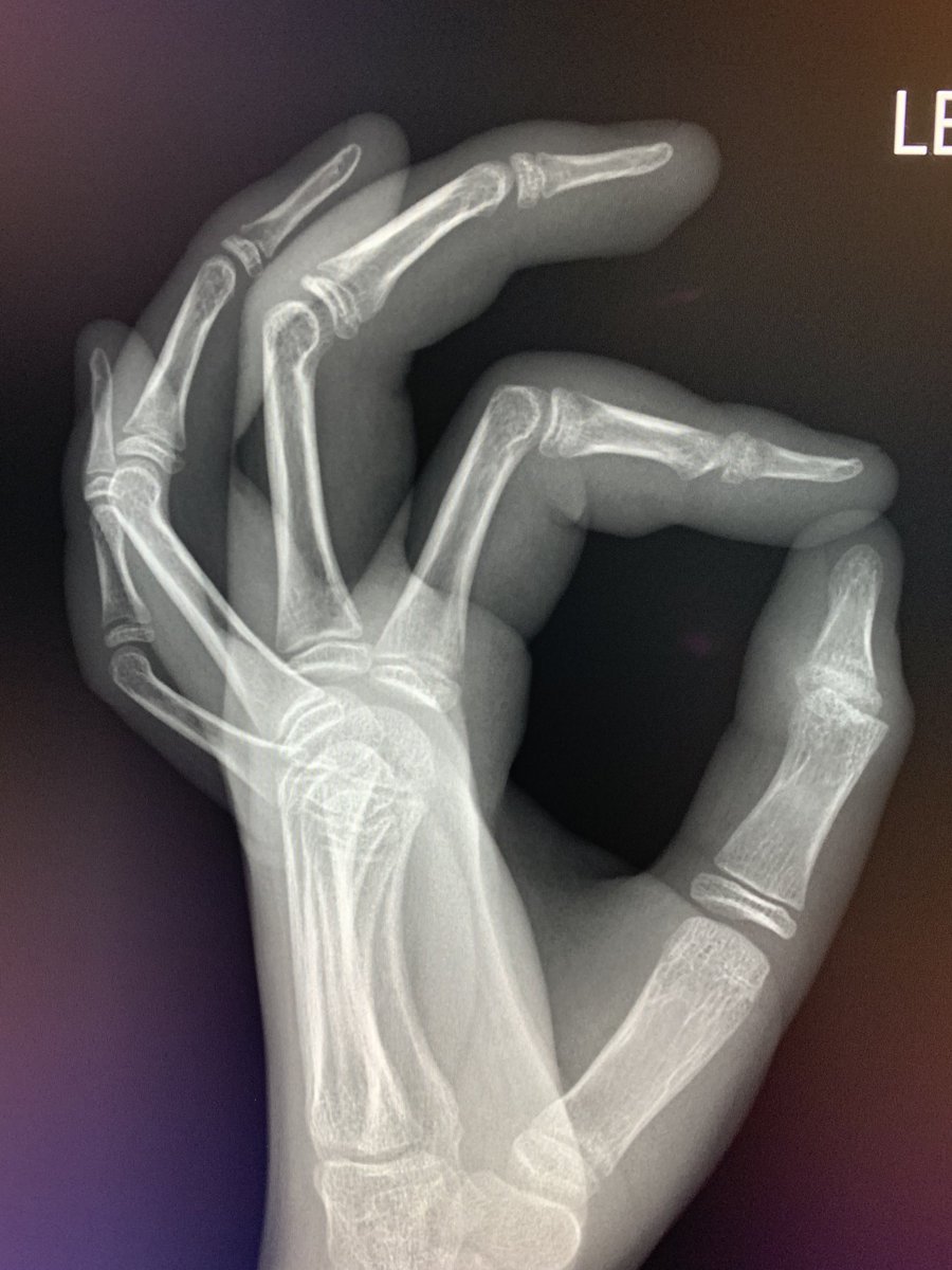 northwoods1980's tweet photo. Favorite case in a while. 10-year-old male with hand pain and swelling presents to pediatrician. Thoughts? https://t.co/caAoS9dvYu