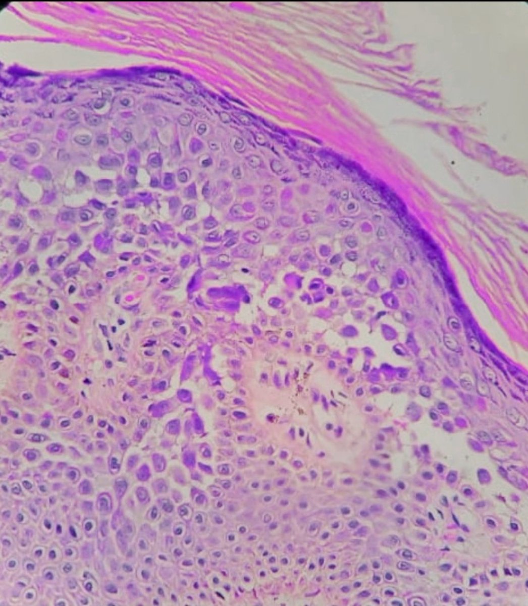 pathognosis22's tweet photo. #Case12 #Hailey Hailey disease : 
*Acantholysis of keratinocytes resembling dilapidated brick wall
*Corps ronds and grains are rare
*Adnexal structures are spared
*IF - Ngeative
*Molecular - mutation ATP2C1 #pathology #pathtwitter #PathArt #dermpath https://t.co/zFcXgoS4At https://t.co/zzLMHTiIPc