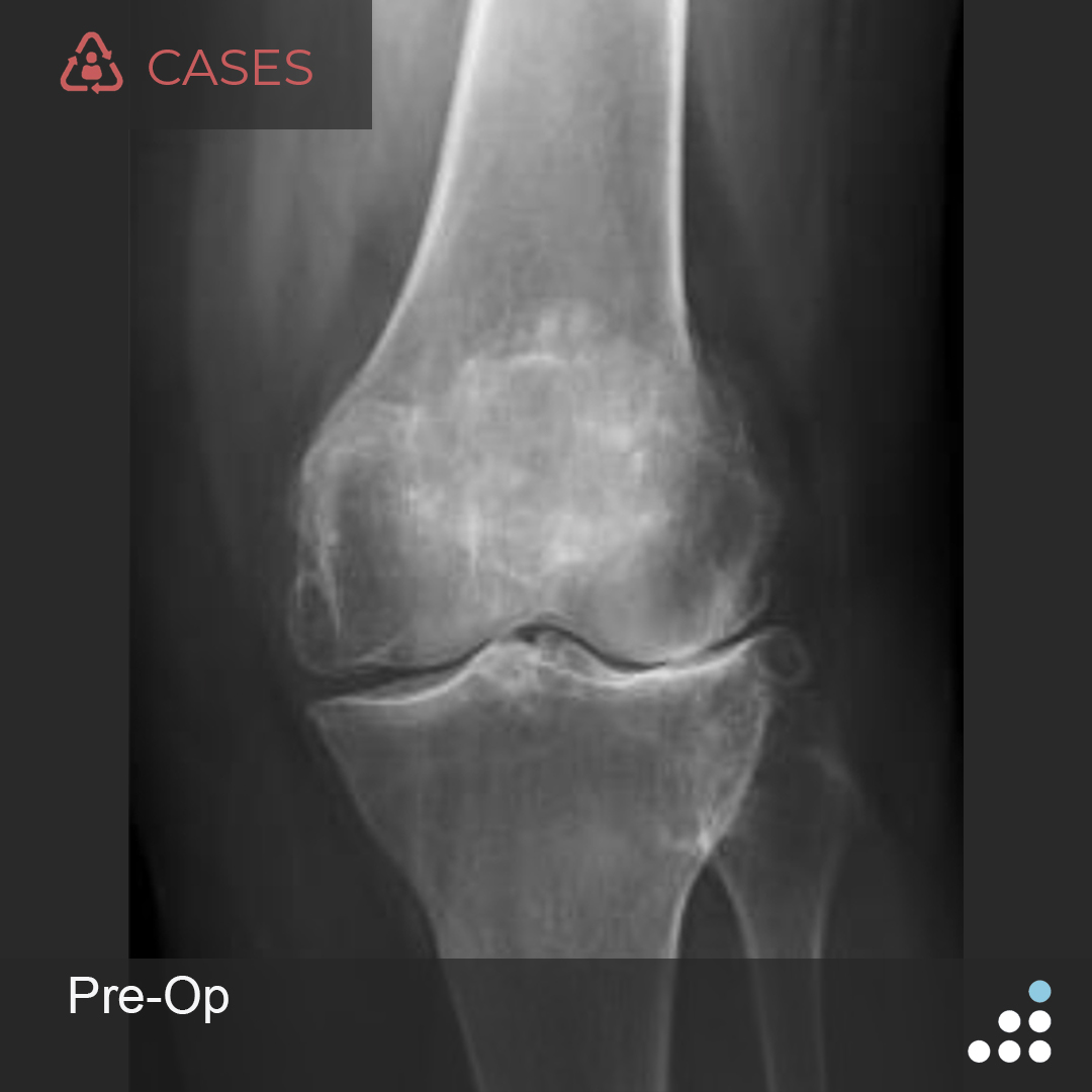 Orthobullets on Twitter "Here’s a new case by Dr. Spencer Schulte