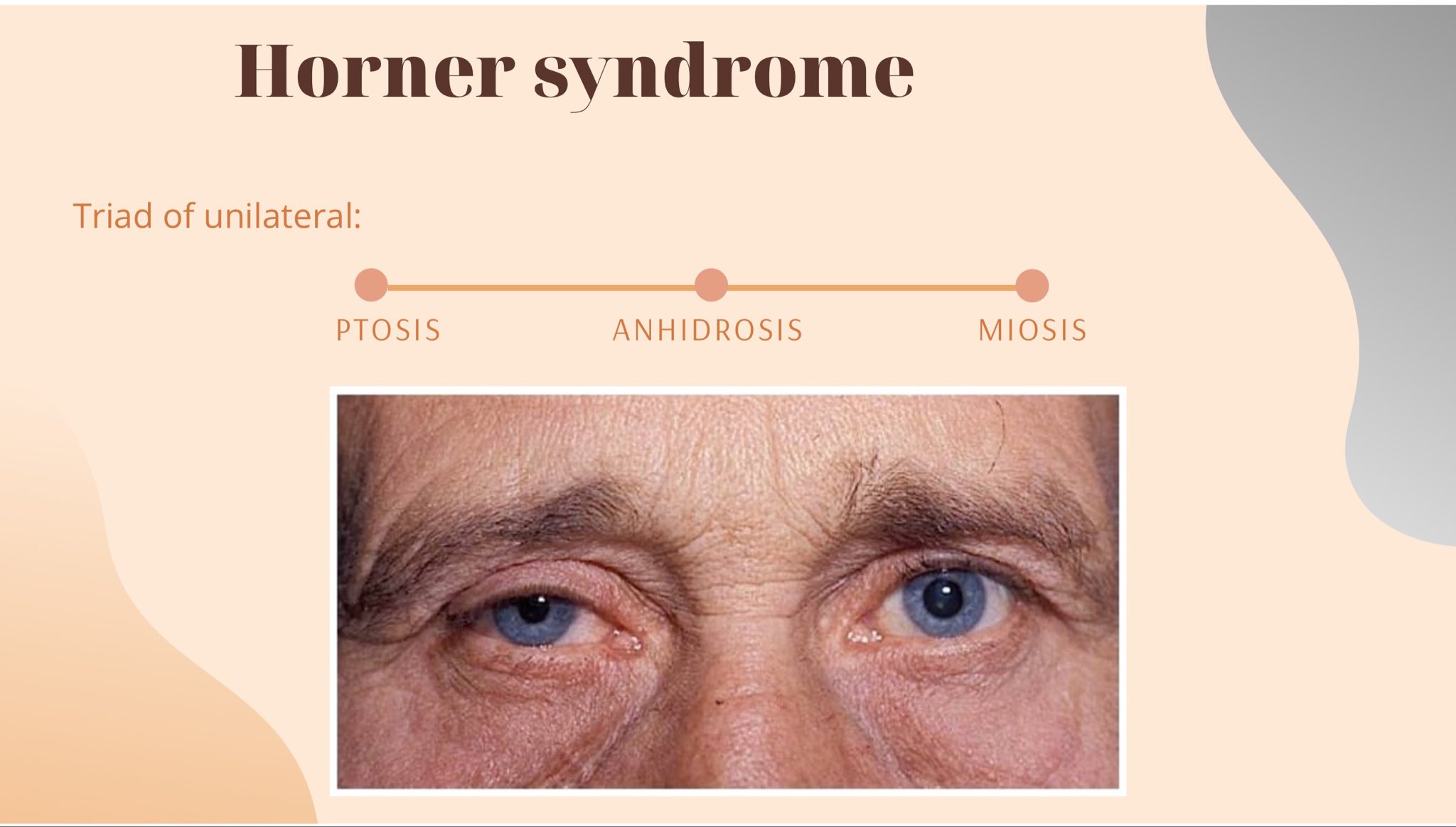 Horner Syndrome What It Is, Causes, Symptoms Treatment, 43 OFF
