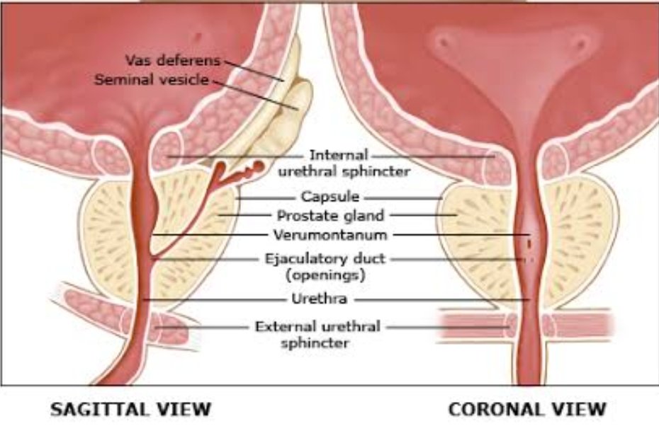 Bismillaah..
Tangkapan Pagi ini..
Prostat sebesar 272 gram..
Keluhan bapak ini y tdk bs kencing.. Ka...