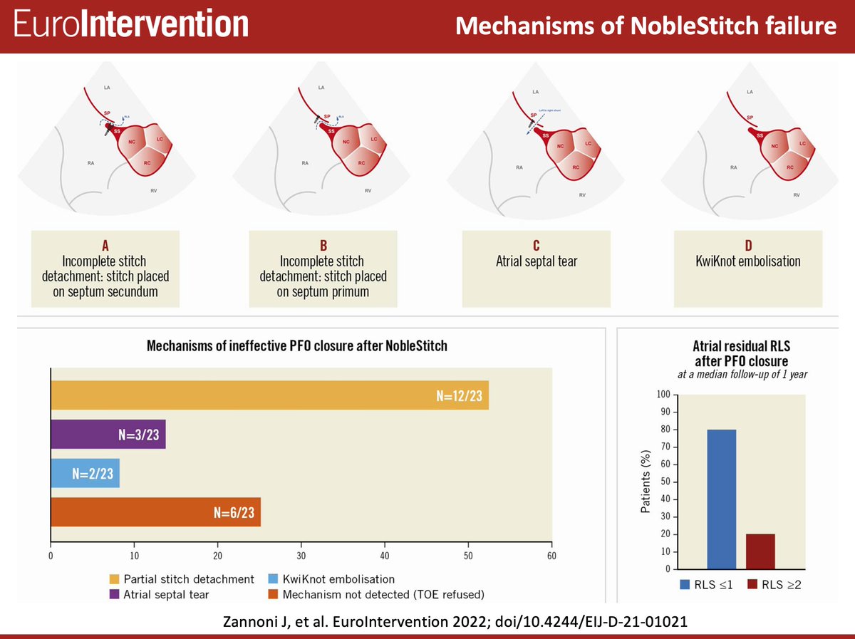 EuroInterventio's tweet photo. Mechanisms of ineffective patent foramen ovale closure using the percutaneous suture-mediated #NobleStitch system. A Research Correspondence by Zannoni J et al. #PFO #EAPCI https://t.co/SsNHWC96RA https://t.co/AZeAg7SieW