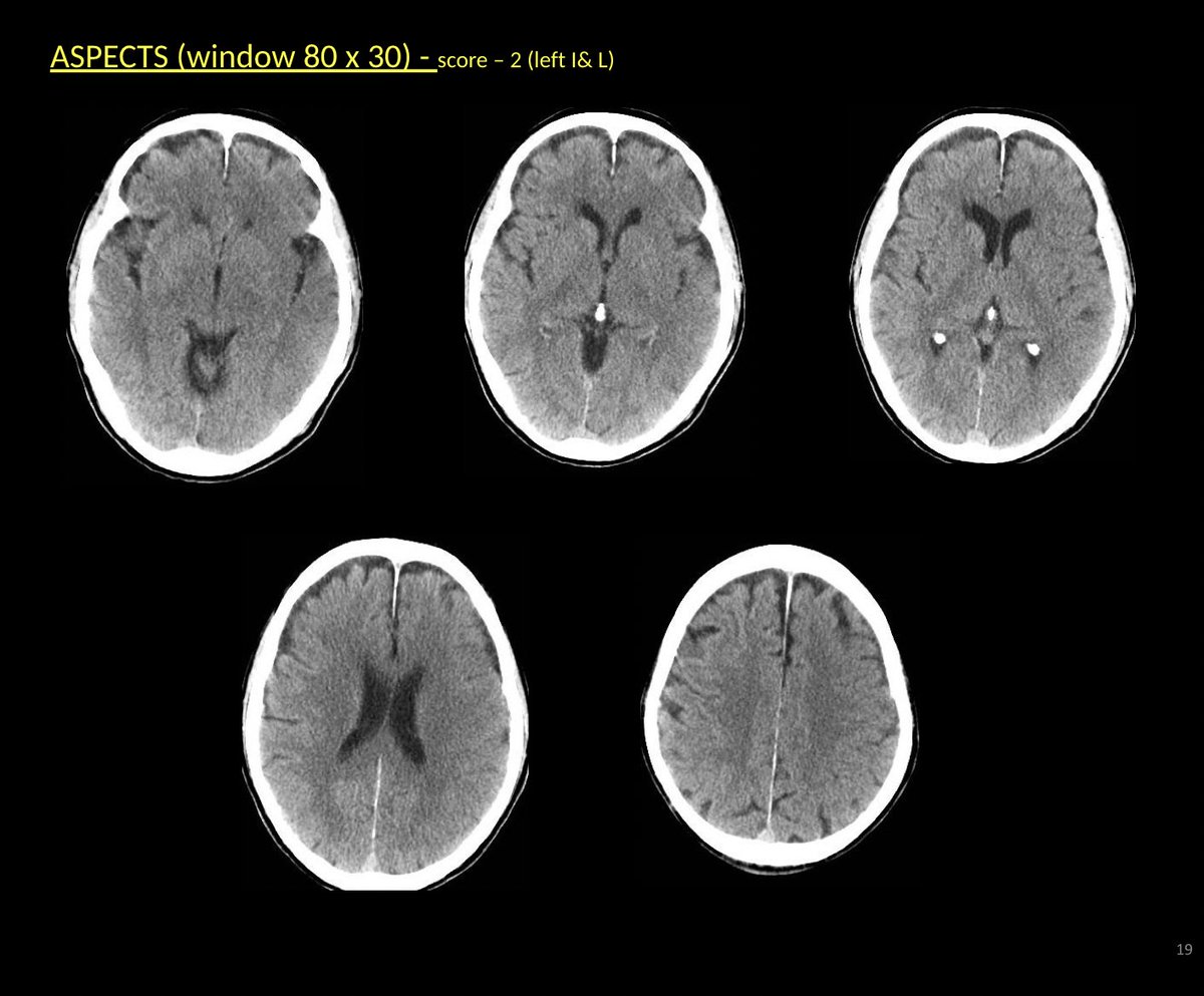 WorldStrokeEd's tweet photo. #MondayTip
✋Avoid scoring #ASPECTS at the standard window level (80x30)
☝🏼Changes are best identified at a scan window of 50x30 approx
👉 https://t.co/8g3mqfe3DT https://t.co/IlDoClHZOc