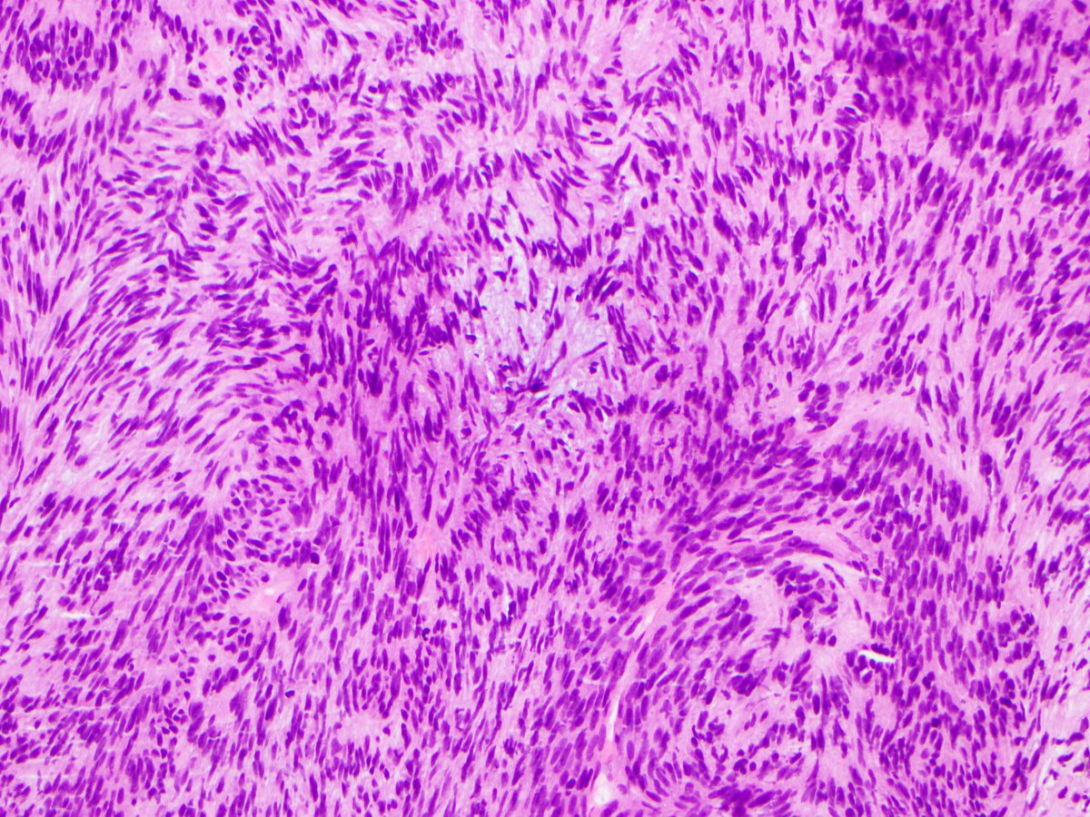 FionaMacPath's tweet photo. OK I feel Yesterday's prostate core may have been too easy. Are you ready for a more challenging case??? Same history as yesterday - PSA only mildly raised &amp; no significant past history. #GUPath #STPath https://t.co/hvWUzh3DZR