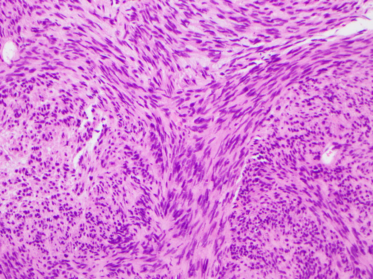 FionaMacPath's tweet photo. OK I feel Yesterday's prostate core may have been too easy. Are you ready for a more challenging case??? Same history as yesterday - PSA only mildly raised &amp; no significant past history. #GUPath #STPath https://t.co/hvWUzh3DZR