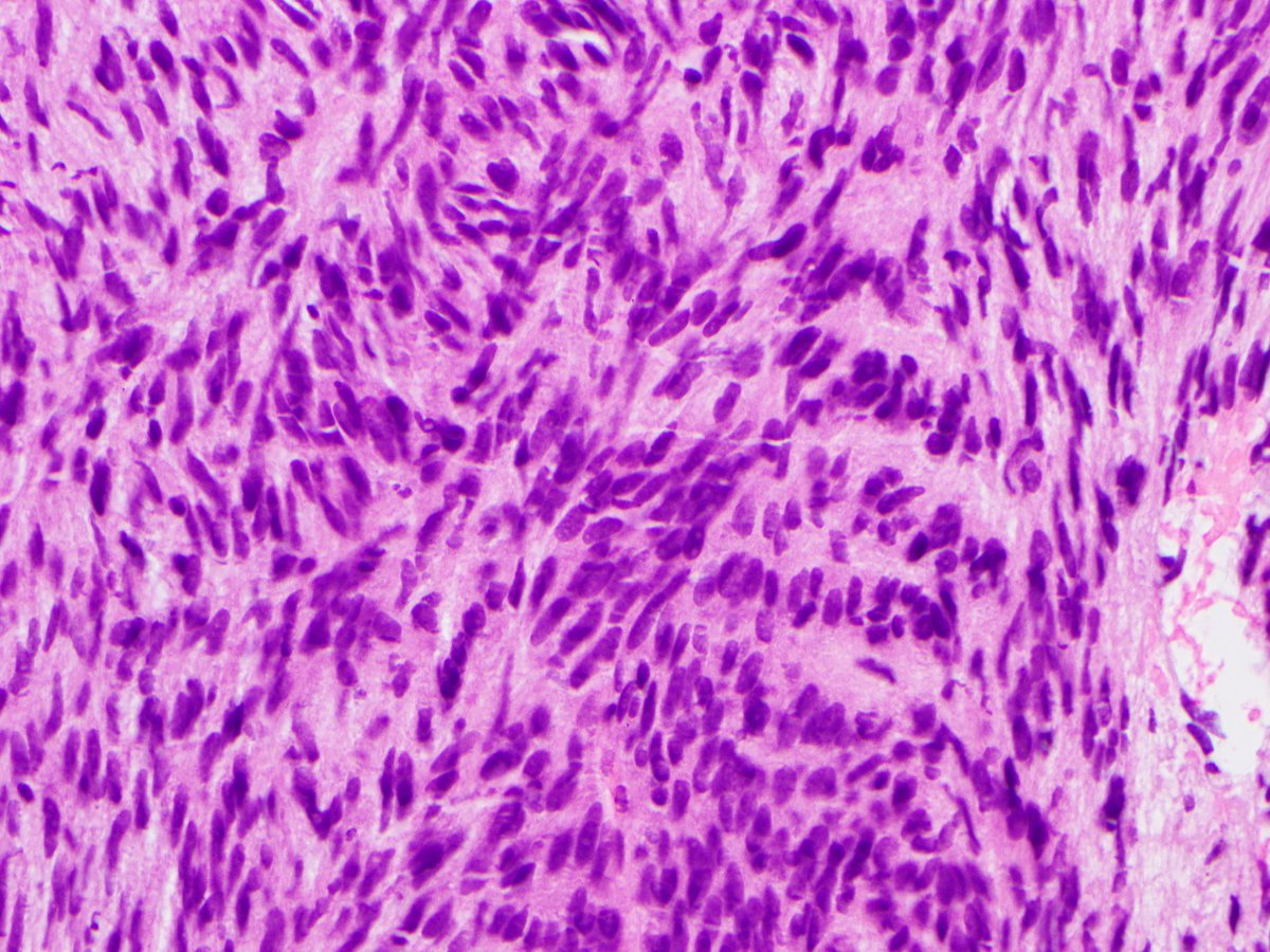 OK I feel Yesterday's prostate core may have been too easy. Are you ready for a more challenging case??? Same history as yesterday - PSA only mildly raised &amp; no significant past history. #GUPath #STPath