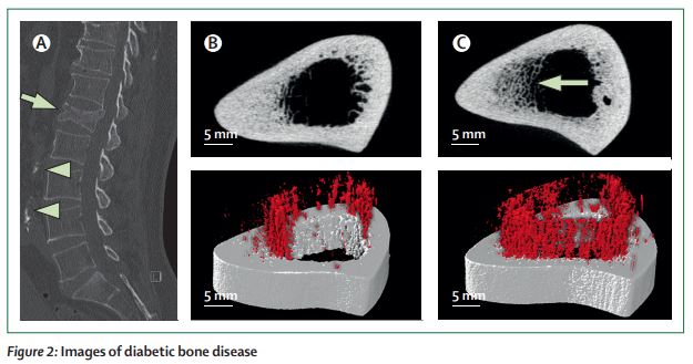 #Bone fragility in #diabetes: novel concepts and clinical implications thelancet.com/journals/landi… #T1D #T2D #osteoporosis #fractures #BMD