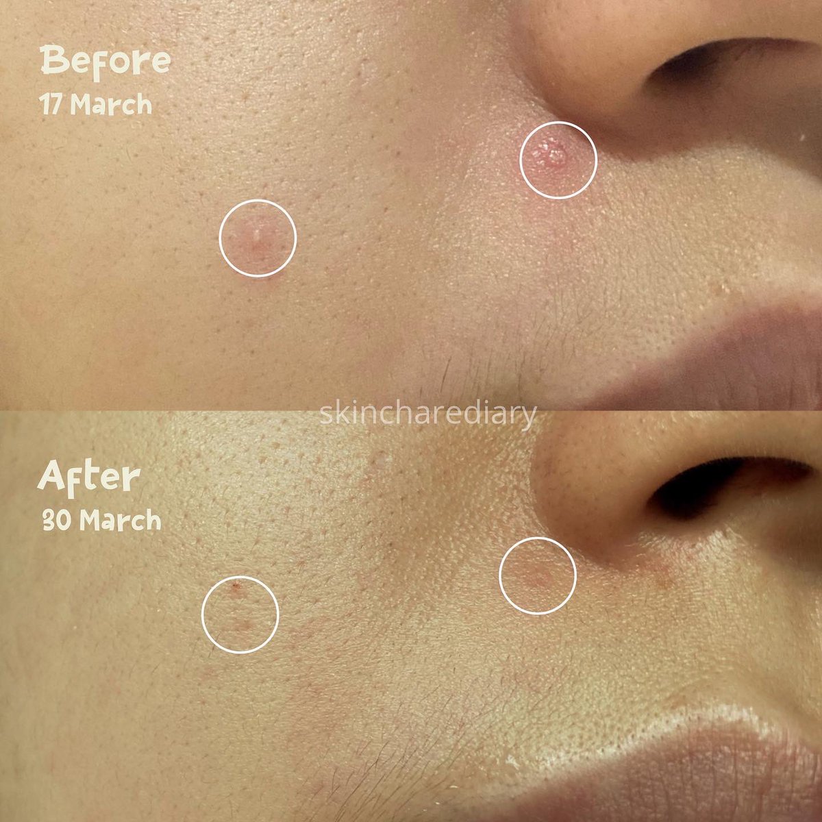 racun face oil yg ampuh buat calming jerawat &amp; redness! 

yg lg cari referensi face oil affordable, ringan, multipurpose &amp; bisa dipakai buat all skin type, simak reviewnya ya 🫶🏻

♡ Adara Cosmetics Noni Glow Concentrate by <a href="/Adara_ID/">Adara Cosmetics Official</a> 

#StepUpnGlow #racuninskincare