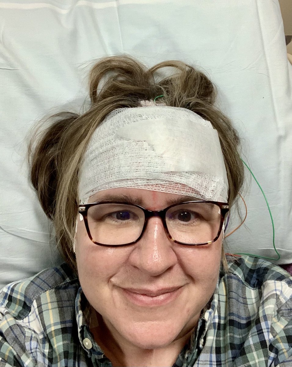 TheSpicedLife's tweet image. Ok last whininess for the night. I swear they have made this LESS comfortable in 20 years. How is that possible? Why cant the electrodes and wires breathe a little? I feel like I have a head wound I am wrapped so tight. #EEG #EEGMonitoring #epilepsy from earlier: