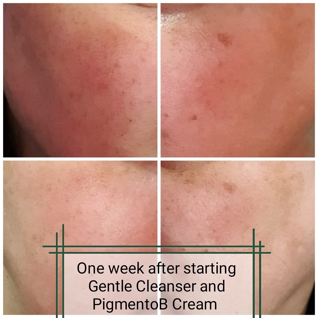 DermoProf's tweet photo. PigmentoB Cream and Booster Serum to help improve the appearance of uneven skin tone and ageing skin. Key Ingredients include Mandelic Acid, Green Tea Extract, Niacinamide, Tranexamic Acid, Linoleic and Linolenic Acid, Bacopa Monierra https://t.co/RZt3NB2QRv