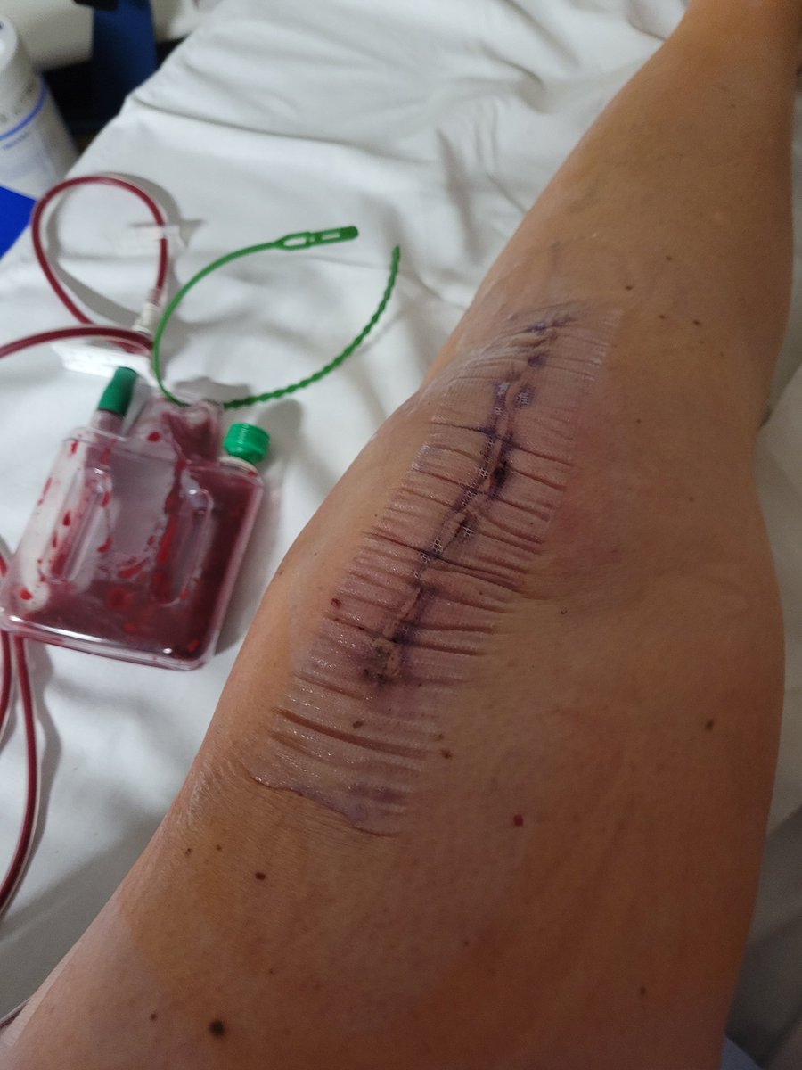 purplelaura24's tweet image. Had knee surgery yesterday and while I was in recovery my blood pressure was low, they told me to think of something exciting, so of course it was being at @frankturner gig and that got the BP going. Looking forward to singing and dancing with #FrankTurnerArmy soon #FTHC