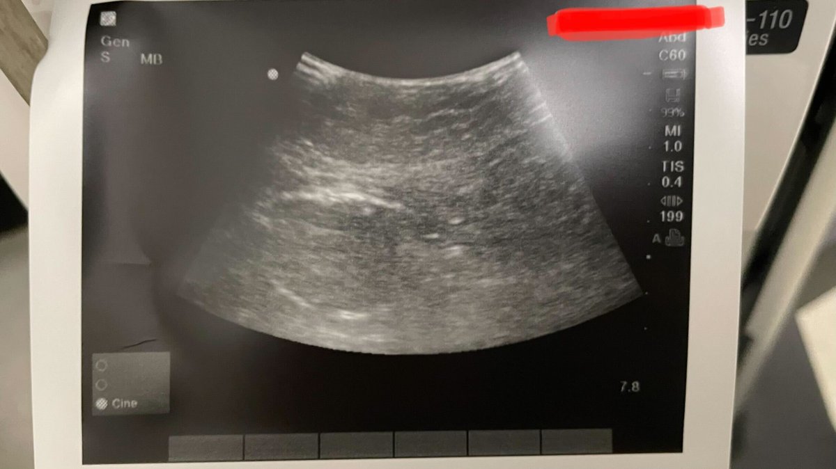 CoapTech's tweet photo. CASE ALERT - First PUG completed! Congrats to Drs. Wang, Cohen, Pyarali, and the clinical team out in Los Angeles, CA. #ultrasoundgastrostomy #TPUG https://t.co/dIwehvtMir