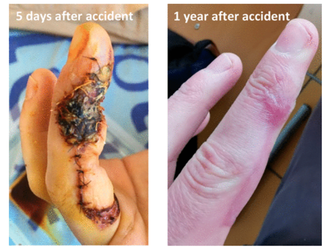 ACSCentSci's tweet photo. #ICYMI
A must-read editorial by @SebVidalChem on lab safety, detailing a case of dichloromethane injection injury. https://t.co/FfjFGVJd6c https://t.co/tTgElZDHzy