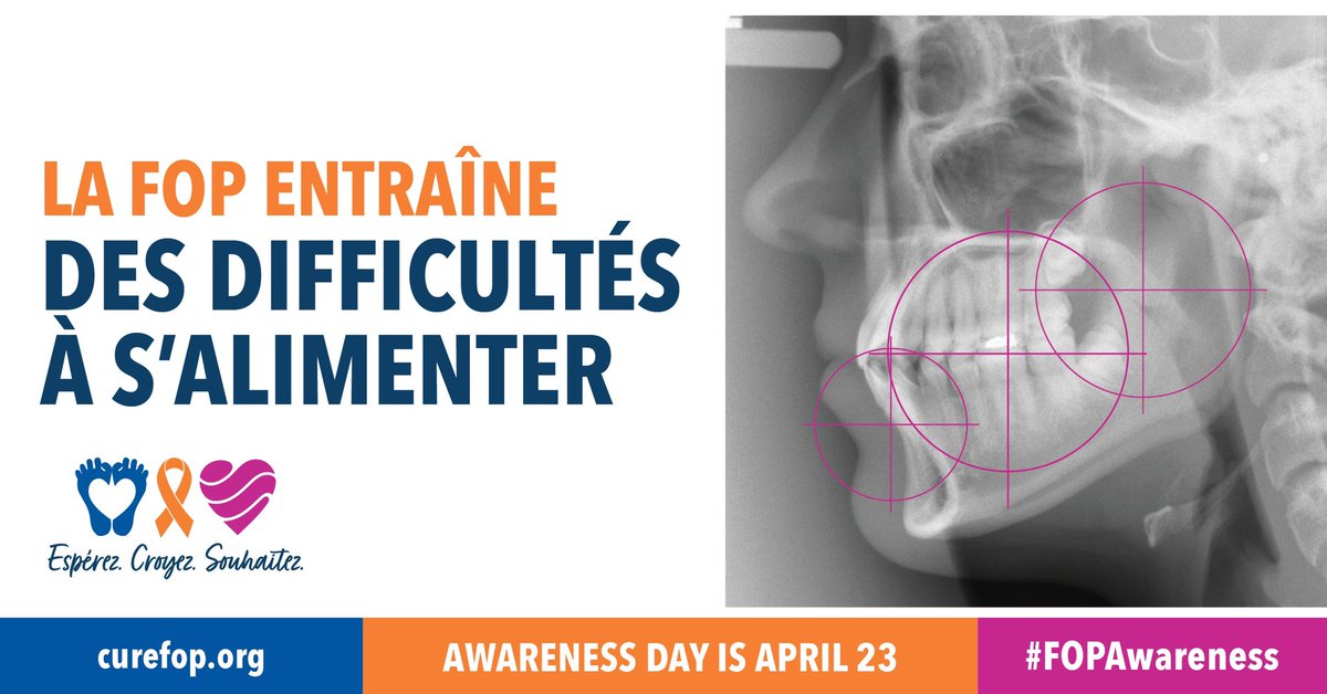 fopfrance's tweet photo. Comme l'os remplace les muscles de la tête, les mâchoires d'une personne peuvent se bloquer, ce qui rend l'alimentation extrêmement difficile.

Les soins dentaires préventifs sont essentiels pour les personnes vivant avec la FOP. https://t.co/1EMSpvr6PN