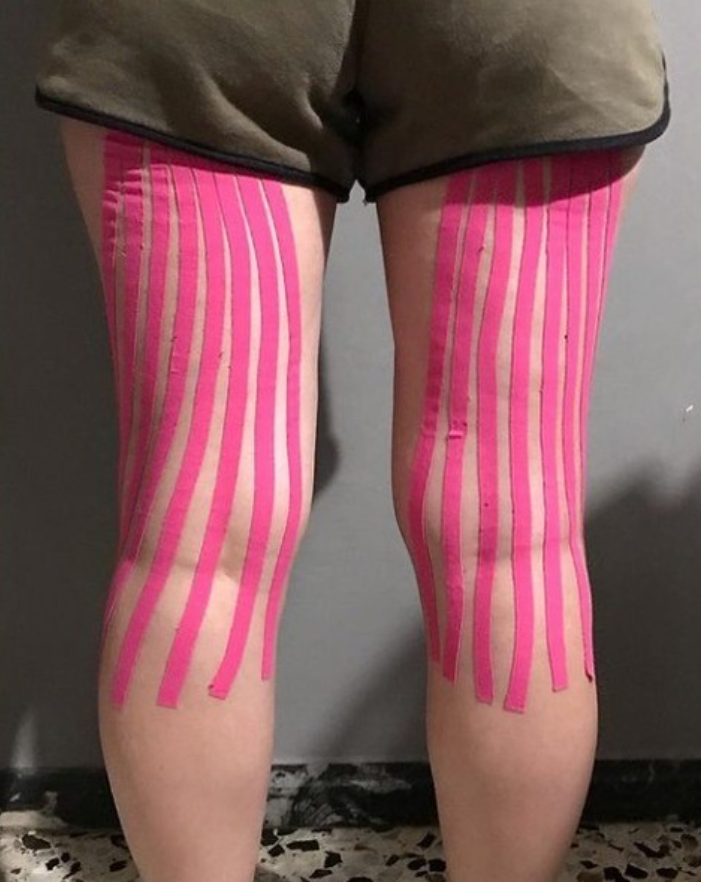 Kinesio_UK's tweet photo. A great example of using #Kinesiotapingmethod on swollen legs, varicose veins ect. This is a great application by @marcotramo_massoterapistamcb
Thanks for sharing
#REPOST https://t.co/QQwN9jhxUv